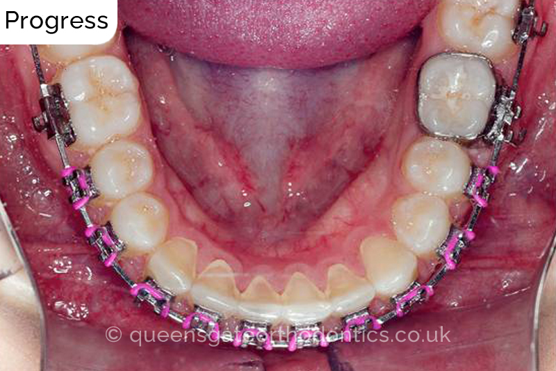 Correction of transposed, palatally impacted upper adult canines and lingually displaced lower canines, class II malocclusion (non – extraction)