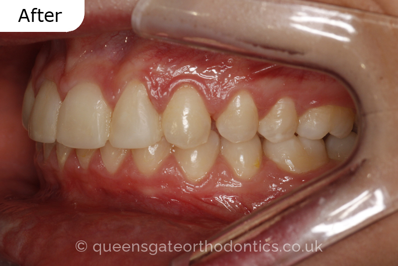 Correction of transposed, palatally impacted upper adult canines and lingually displaced lower canines, class II malocclusion (non – extraction)