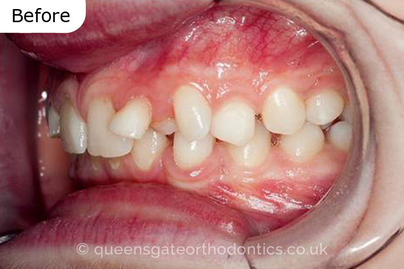 Correction of transposed, palatally impacted upper adult canines and lingually displaced lower canines, class II malocclusion (non – extraction)