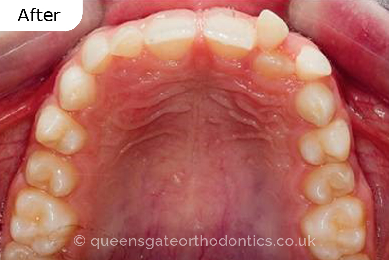 Correction of transposed, palatally impacted upper adult canines and lingually displaced lower canines, class II malocclusion (non – extraction)