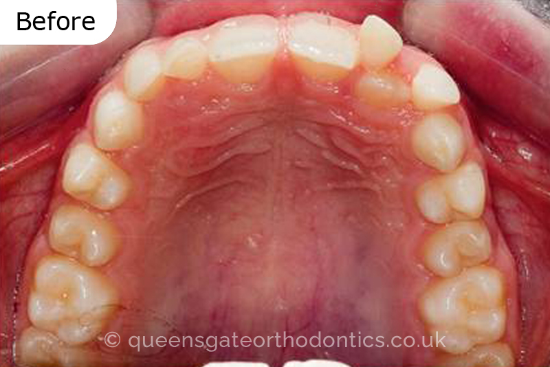 Correction of transposed, palatally impacted upper adult canines and lingually displaced lower canines, class II malocclusion (non – extraction)