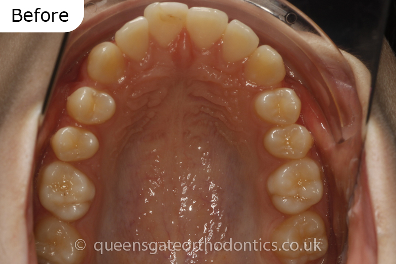 correction of prominent teeth