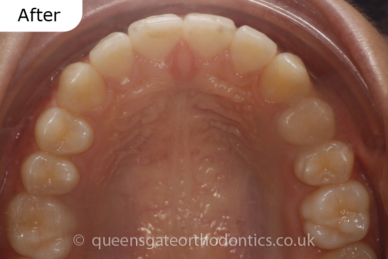 correction of prominent teeth