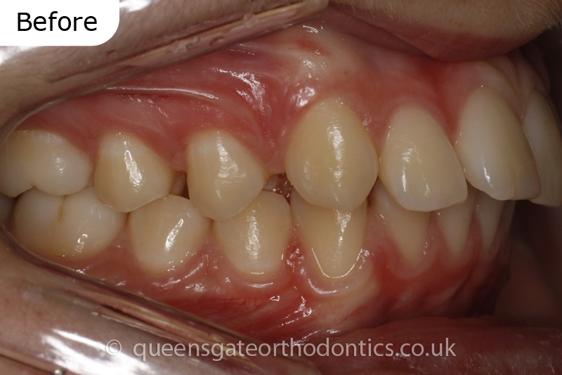 correction of prominent teeth