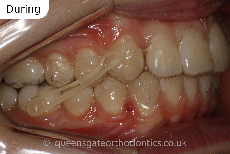 correction of prominent teeth