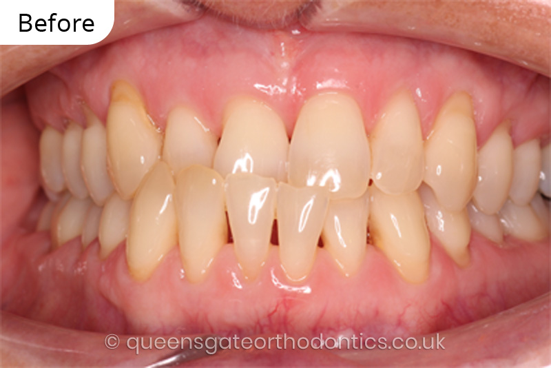 correction of anterior crossbite