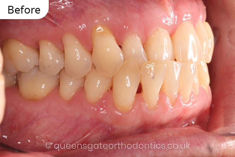 correction of anterior crossbite