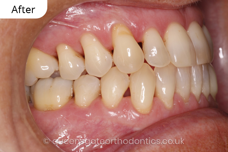 correction of anterior crossbite