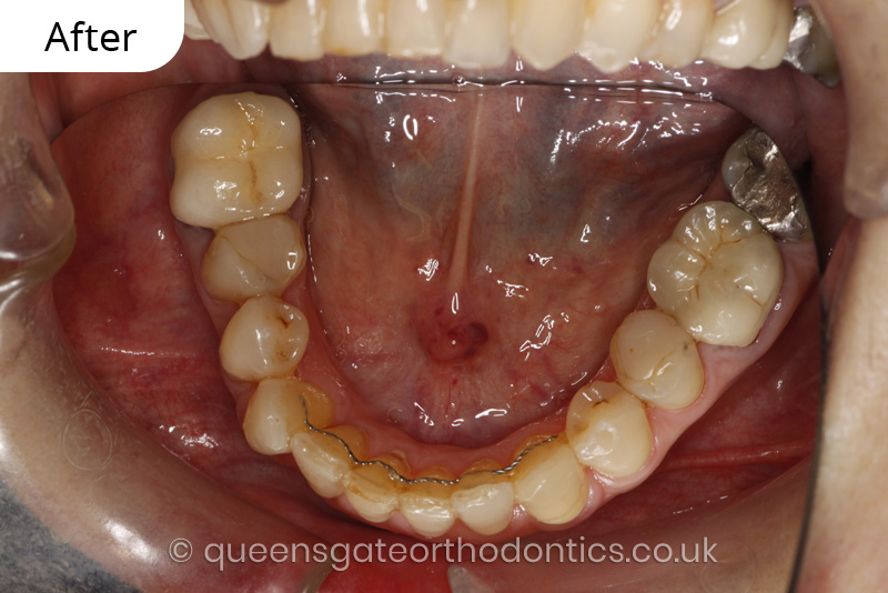 correction of crowding and posterior crossbite