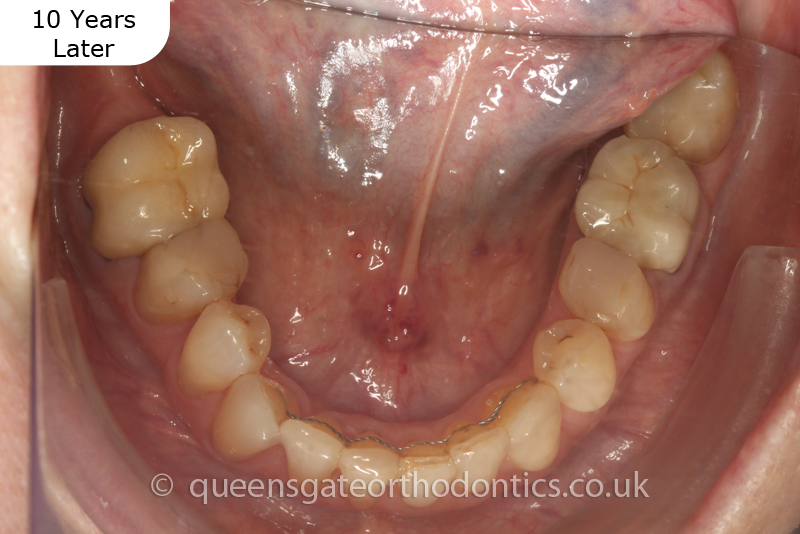 Correction of crowding and posterior crossbite