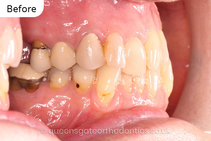 correction of crowding and posterior crossbite