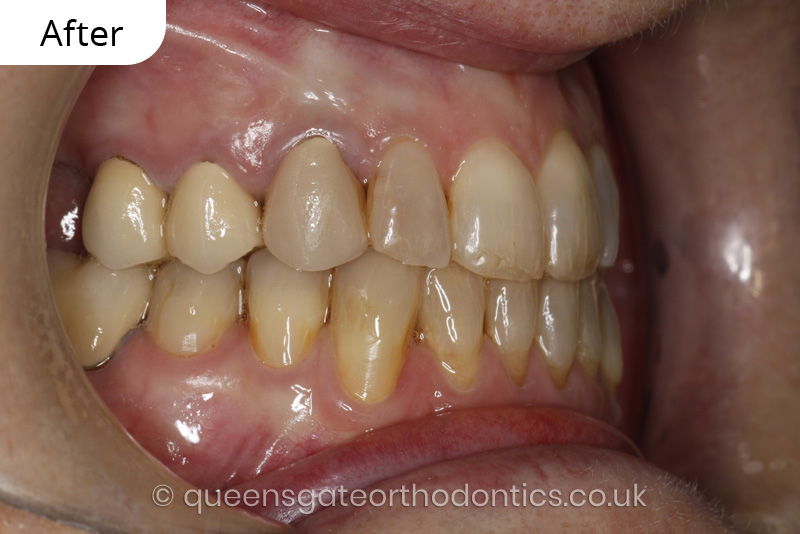 correction of crowding and posterior crossbite