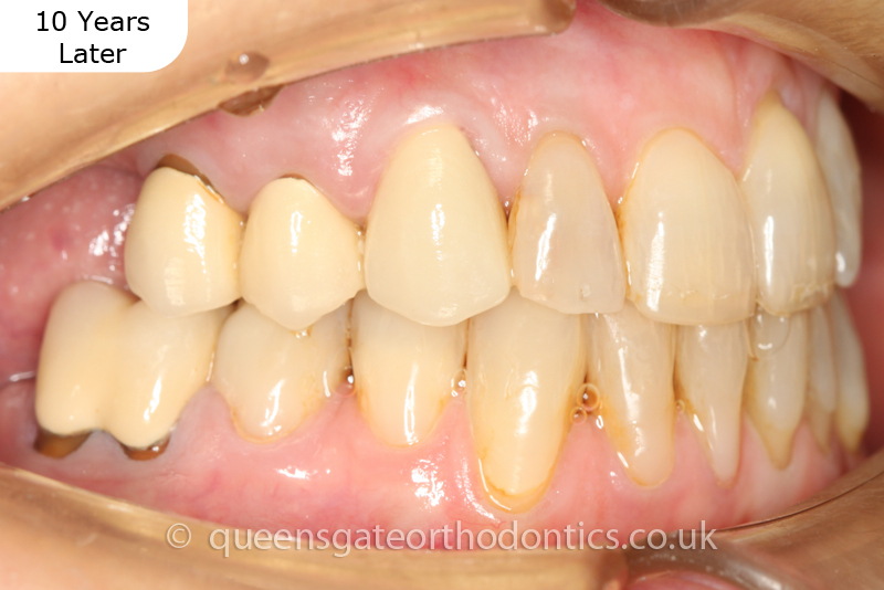 correction of crowding and posterior crossbite