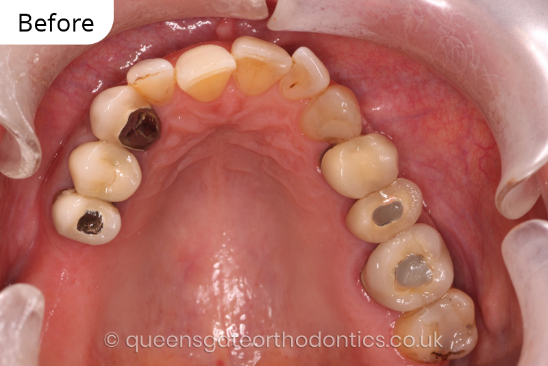 correction of crowding and posterior crossbite