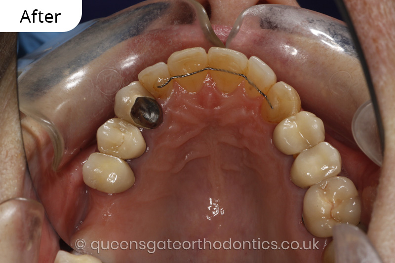 correction of crowding and posterior crossbite