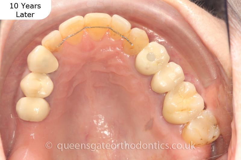 correction of crowding and posterior crossbite