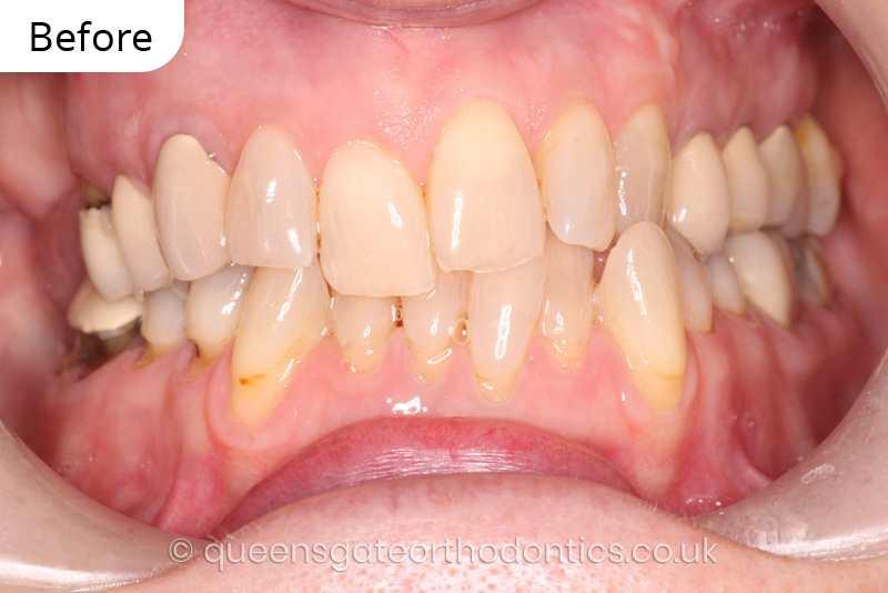 correction of crowding and posterior crossbite