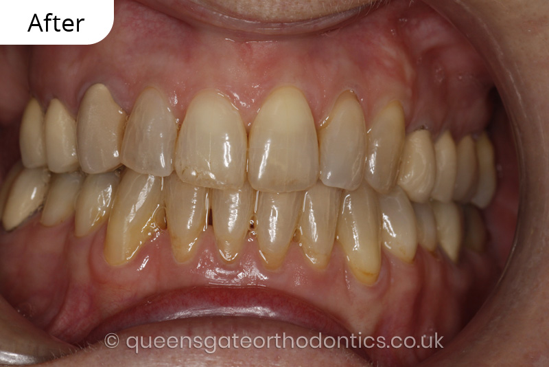 correction of crowding and posterior crossbite