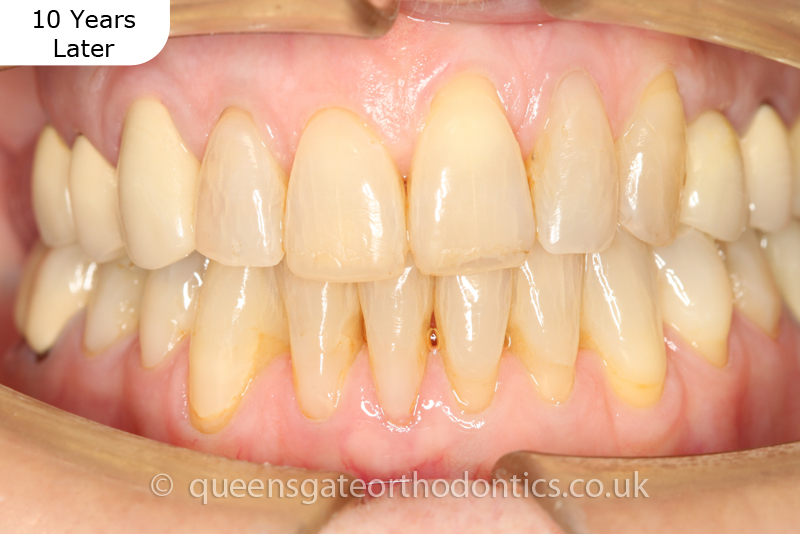 correction of crowding and posterior crossbite