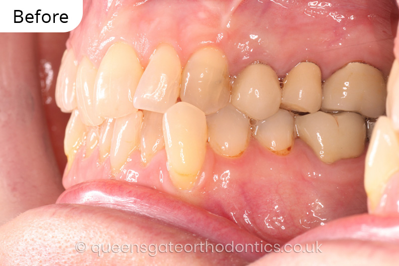 correction of crowding and posterior crossbite