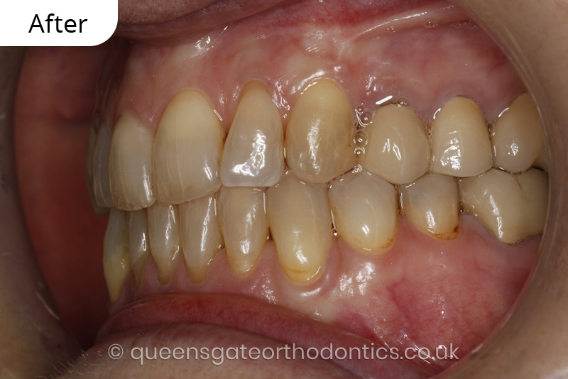 correction of crowding and posterior crossbite