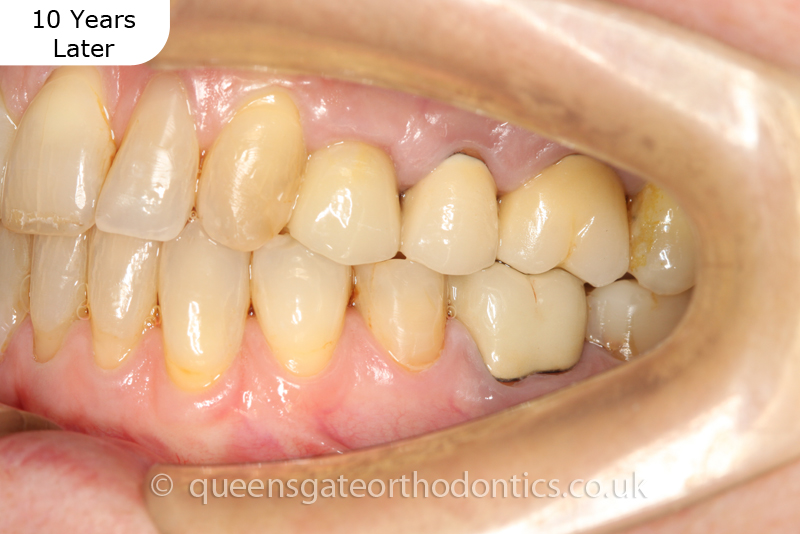 correction of crowding and posterior crossbite