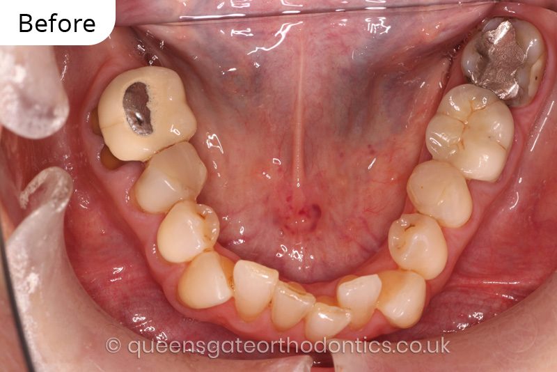 correction of crowding and posterior crossbite