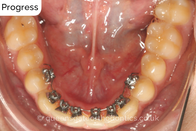 Lingual Braces