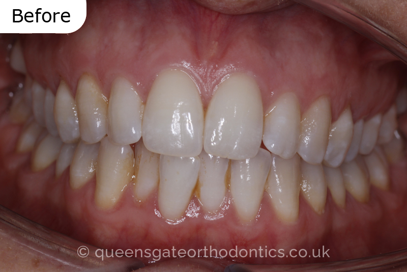Lingual Braces